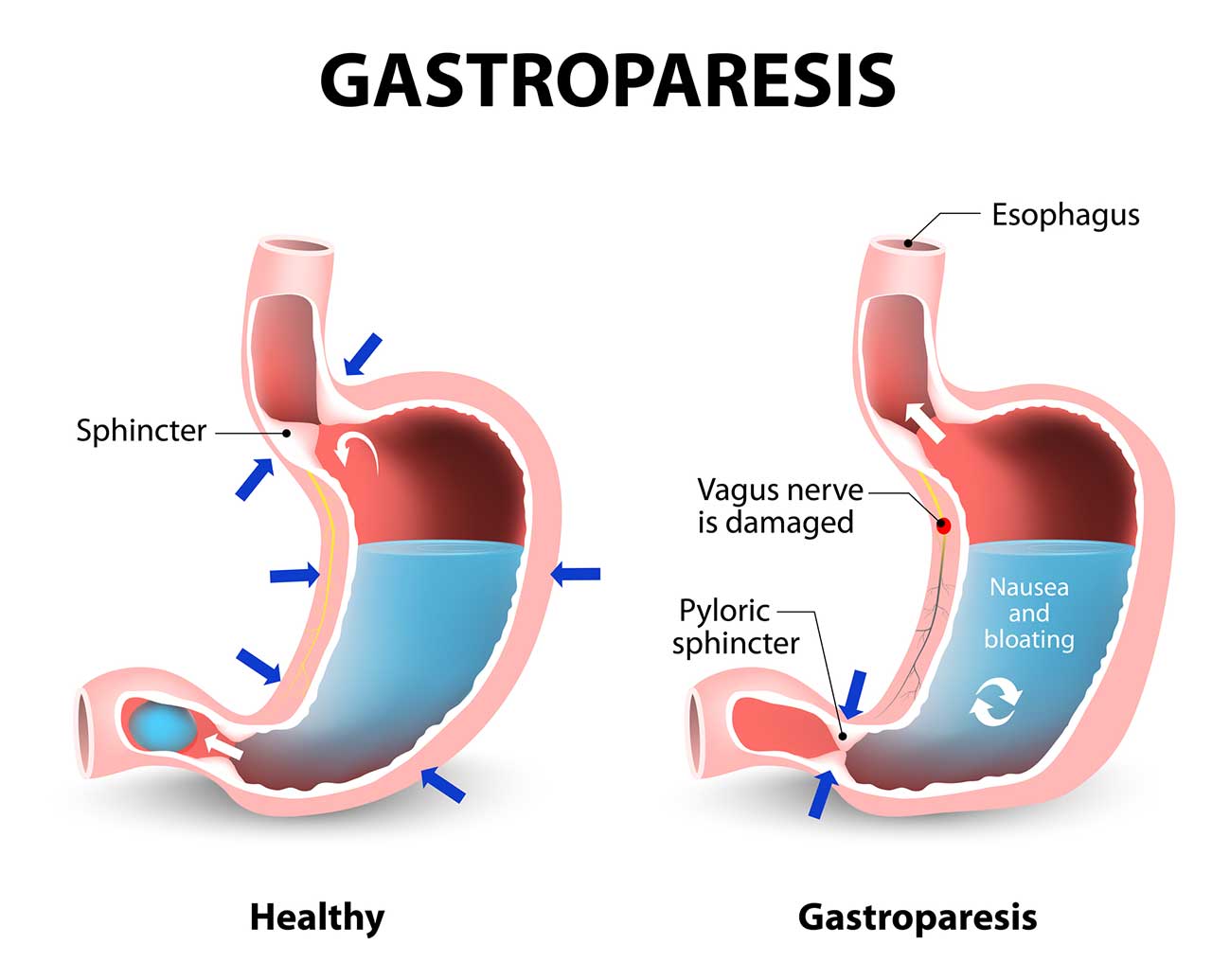 Gastroparesis Diet Tips